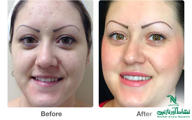 قبل و بعد از عمل هیدرودرمی/ هیدرودرمی پوست